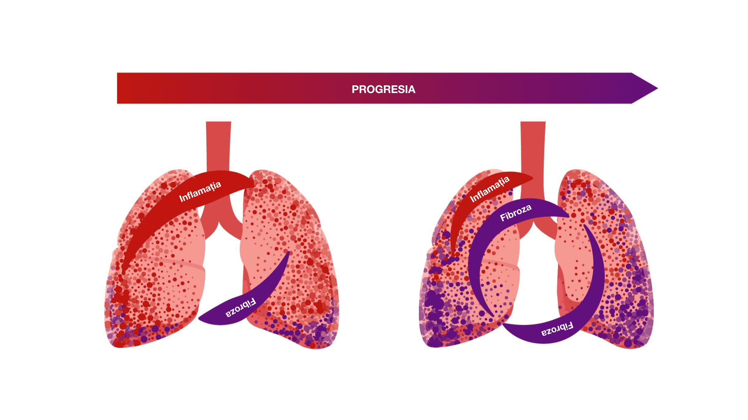 Progresia fibrozei care se autosusține