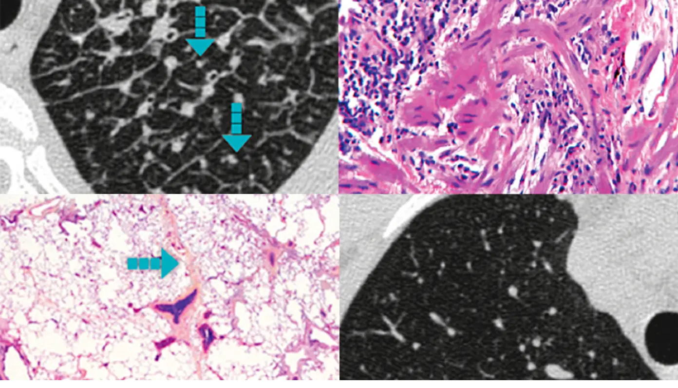 4 scanări imagistice, reprezentând PID fibrozate și caracteristice pentru aceste patologii pulmonare.