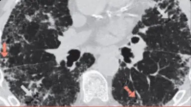 Exemplu de bronșiectazie /bronșiectazie de tracțiune PID pe HRCT