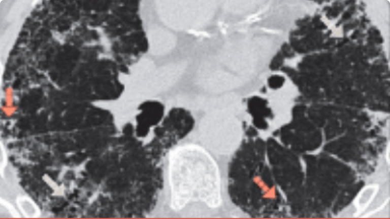 Imagine HRCT a bronhiolectaziei.