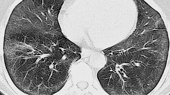 Exemplu de model PIINS pe HRCT