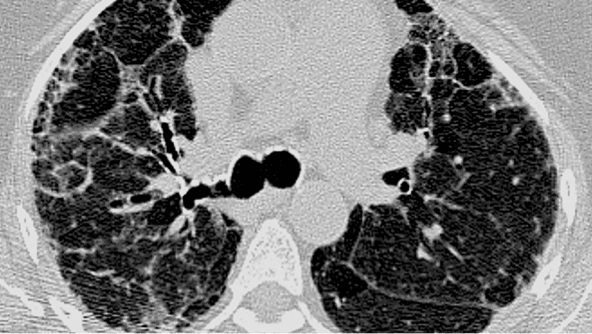 Exemplu de model cHP pe HRCT