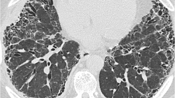 Exemplu de model IPF UIP pe HRCT