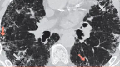 Imagine HRCT a bronsiectaziei.